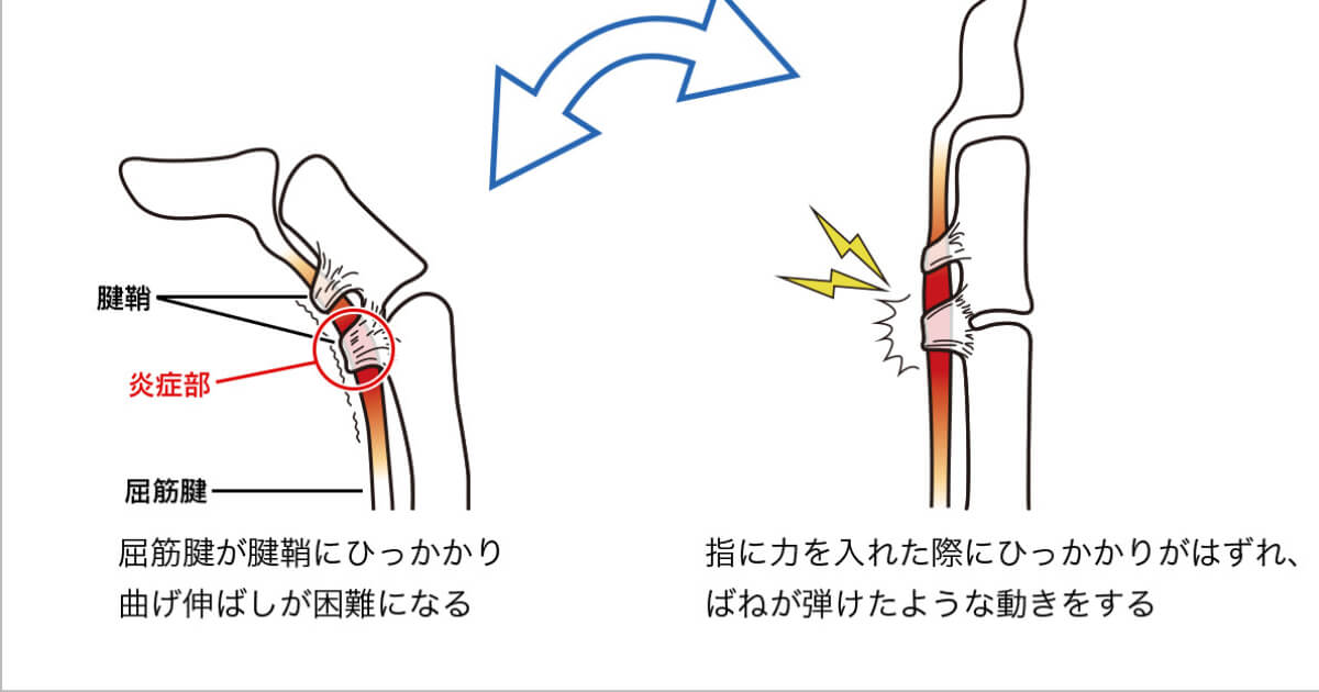 ばね指の原因はこれだ